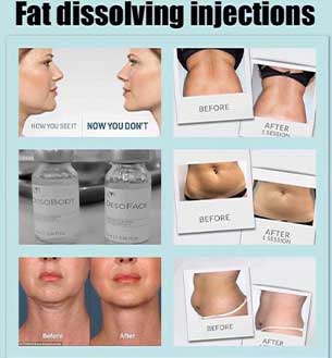 fat dissolving injections before and after
